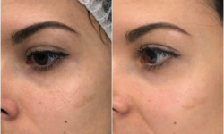 Мезотерапія глутатіоном для висвітлення пігментації Лікар-косметолог Юлія Луцьк