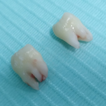 Видалення зубів мудрості