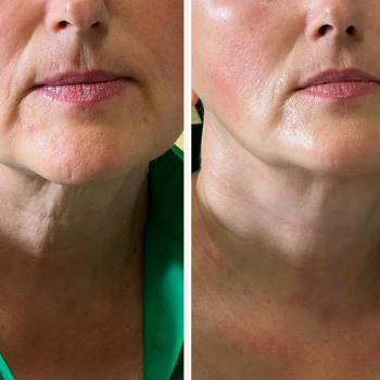  
До и после применения мезобустера