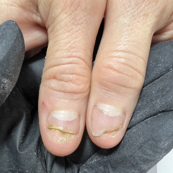 Оніхоліз при грибковій інфекції