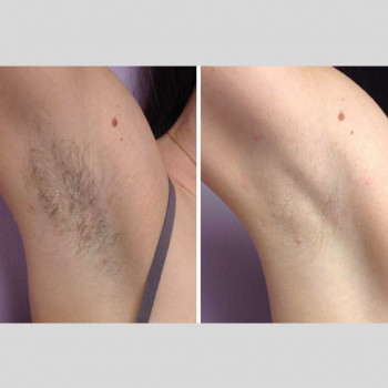 Лазерна епіляція
                    Косметологічний центр  Київ