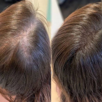 Результат після восьми процедур мезотерапії.