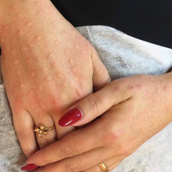 Біоревіталізація рук