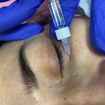 Перед процедурою наноситься крем-анестетик з лідокаїном!))