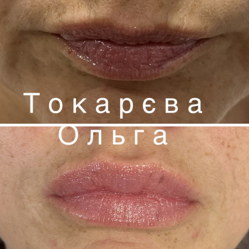 Збільшення губ