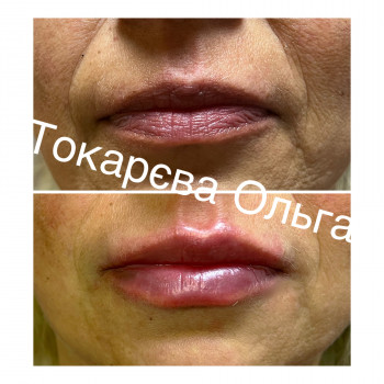 Омолодження губ