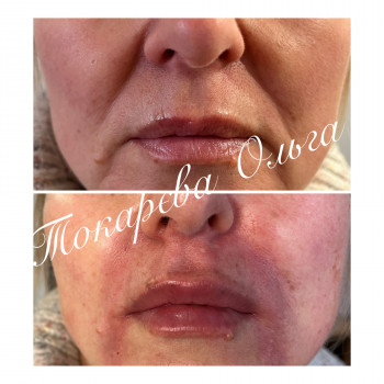 Корекція носогубних зморшок