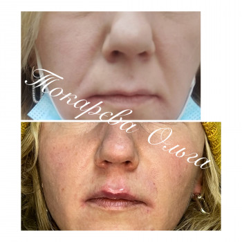 Заповнення носогубних зморшок