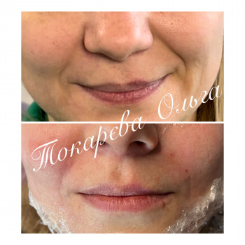 Заповнення носогубних зморшок