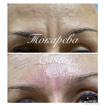 Ботокс міжбровка+ заповнення зморшки філером