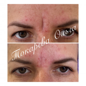 Ботокс міжбровка+ заповнення філером