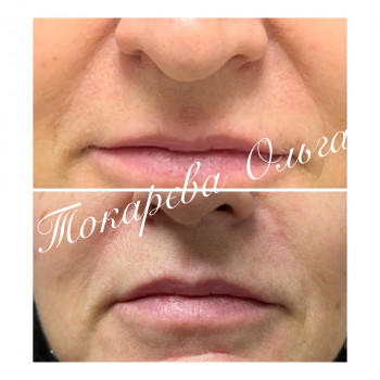 Корекція носогубної зморшки