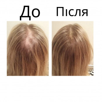 мезотерапія до/після