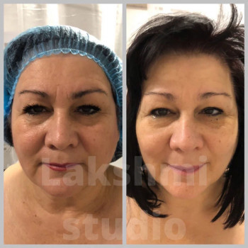 Результати процедури Smas ліфтингу