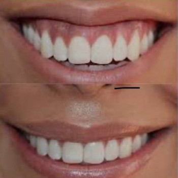 Прибирання "ясеневої посмішки"