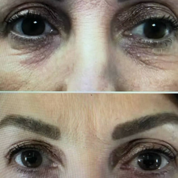 Ін'єкційна програма навколо очей