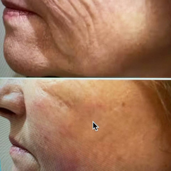 Редермалізація SuneKos