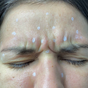 Ботулінотерапія "до"