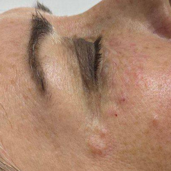 Програма боротьби з мілкими зморшками та набряками навколо о