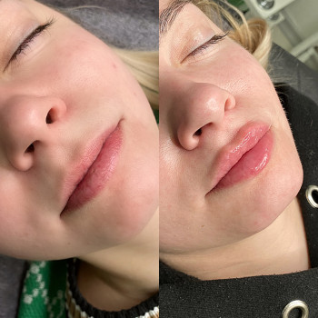 Збільшення губ