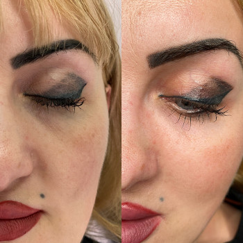 Заповнення носослізної борозни