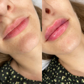 Збільшення губ