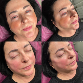 Контурна пластика