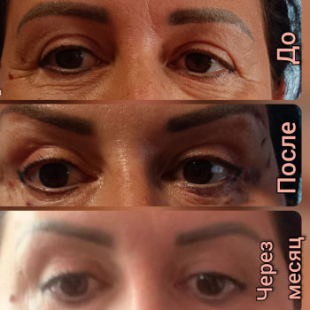 Ниткове армування