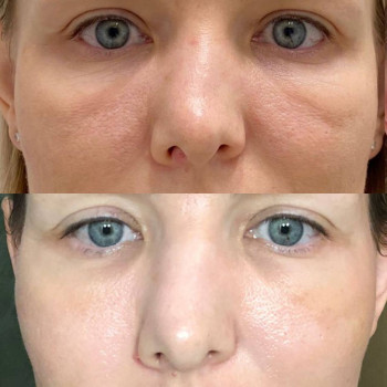 4 процедури ниткового армування малярних мішків