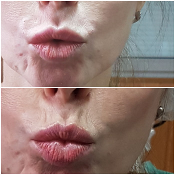 1 процедура ниткового армування кісетних зморшок