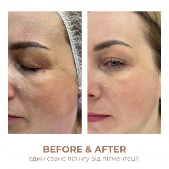 Лікування пігментації, підбір засобів проти пігментних плям