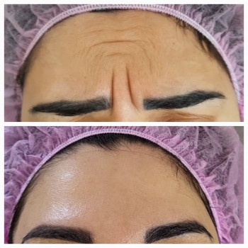 Ботокс мимических морщин
                    Косметолог-инъекционист Анастасия Харьков