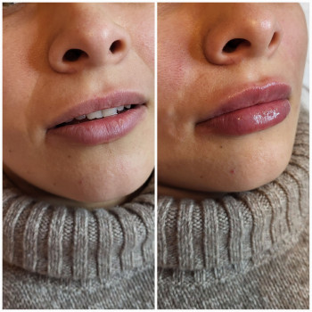 Омоложение губ/носогубных складок
                    Косметолог-инъекционист Анастасия Харьков