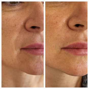 Омоложение губ/носогубных складок
                    Косметолог-инъекционист Анастасия Харьков