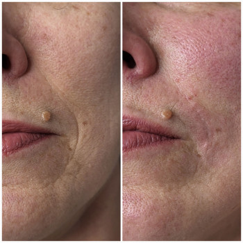 Омоложение губ/носогубных складок
                    Косметолог-инъекционист Анастасия Харьков