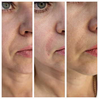 Омоложение губ/носогубных складок
                    Косметолог-инъекционист Анастасия Харьков