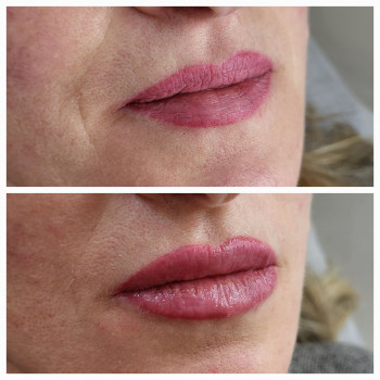 Омоложение губ/носогубных складок
                    Косметолог-инъекционист Анастасия Харьков