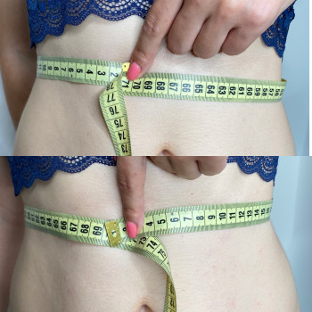 Одразу після процедури,через тиждень оцінюєм повний результа