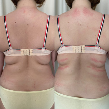 Одразу після процедури 
Ще є набряк