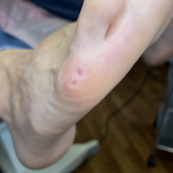 Видалення мозолів
                    Подолог Анна Днепр