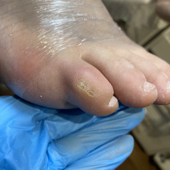 Видалення мозолів
                    Подолог Анна Днепр