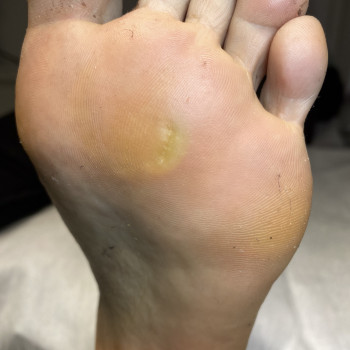 Видалення мозолів
                    Подолог Анна Днепр