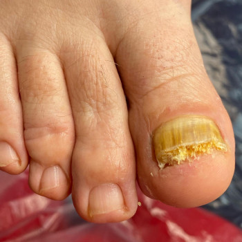 Грибок нігтів
                    Подолог Анна Дніпро