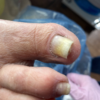 Грибок нігтів
                    Подолог Анна Дніпро