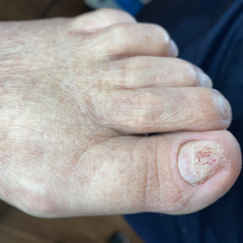 Грибок нігтів
                    Подолог Анна Дніпро