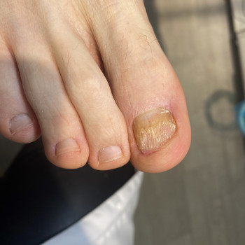 Грибок нігтів
                    Подолог Анна Дніпро