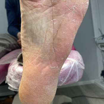 Грибок нігтів
                    Подолог Анна Дніпро