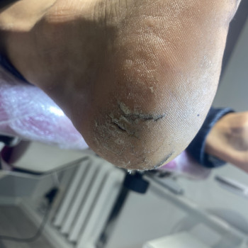 Обробка тріщин
                    Подолог Анна Днепр