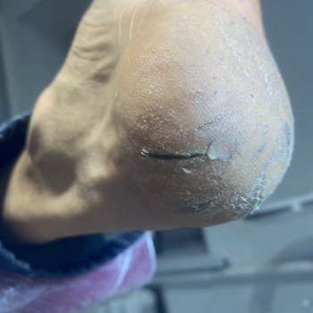 Обробка тріщин
                    Подолог Анна Днепр