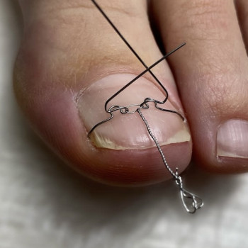 Корекція врослого нігтя